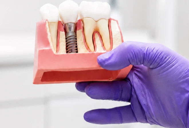 Modelo clínico de implante dental osteointegrado